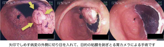 内視鏡的胃粘膜下層剥離術画像