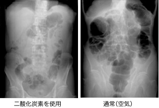 大腸内視鏡検査画像