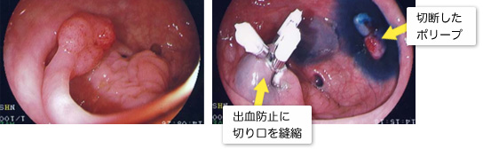 大腸ポリペクトミー画像