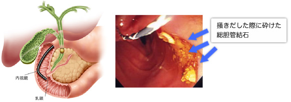 内視鏡による総胆管結石除去画像
