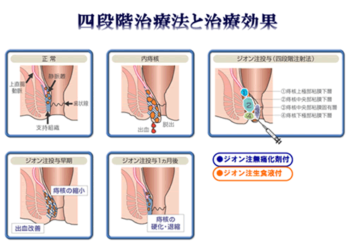 ＡＬＴＡ法