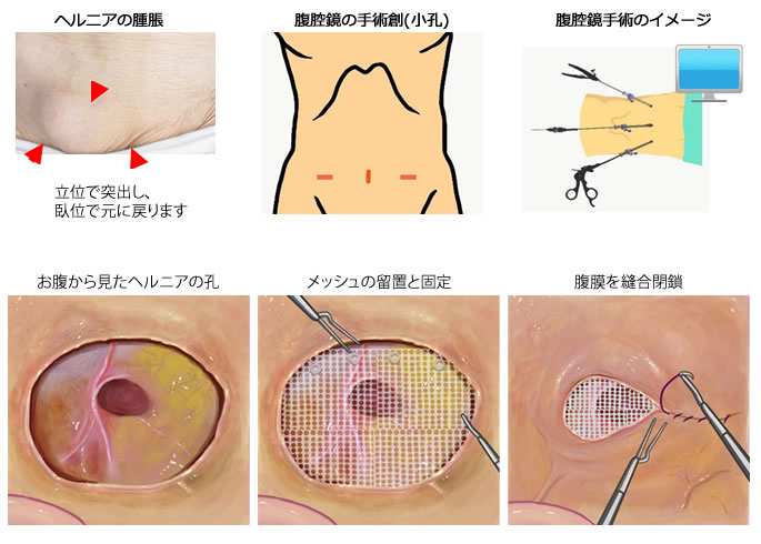 腹腔鏡下ヘルニア修復術